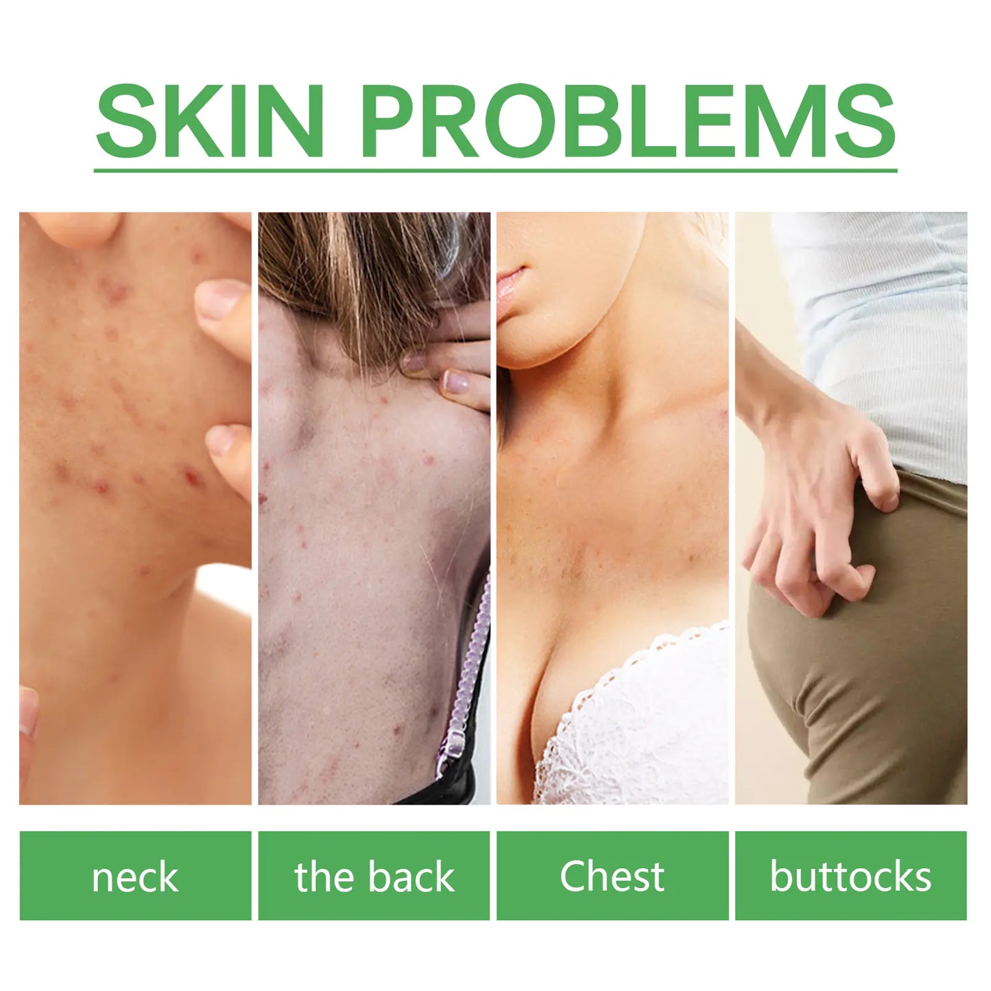 BODY ACNE REMOVING ESSENCE